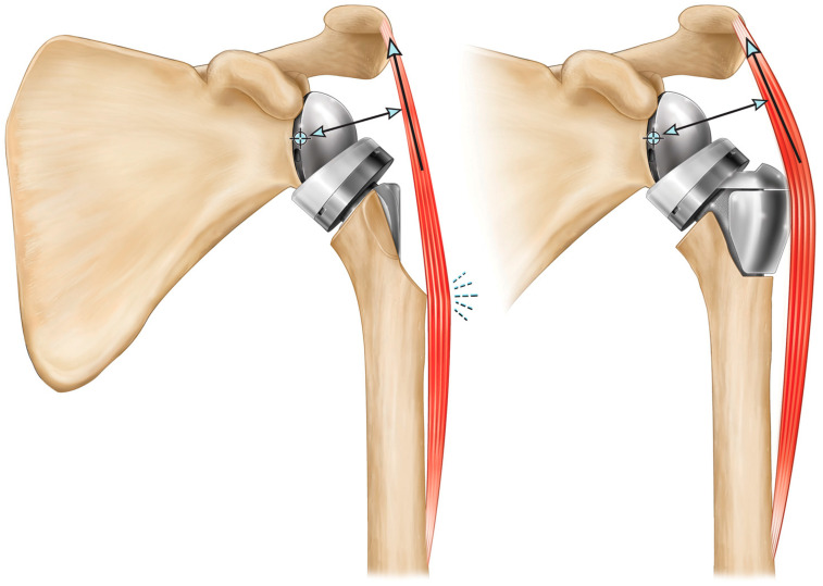 protesi inversa spalla