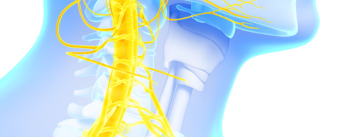 sindrome di Parsonage Turner